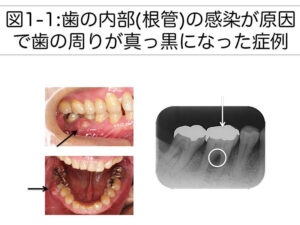 レントゲンで、歯根の周りに膿がある原因は？パート1（歯内歯周病変について)