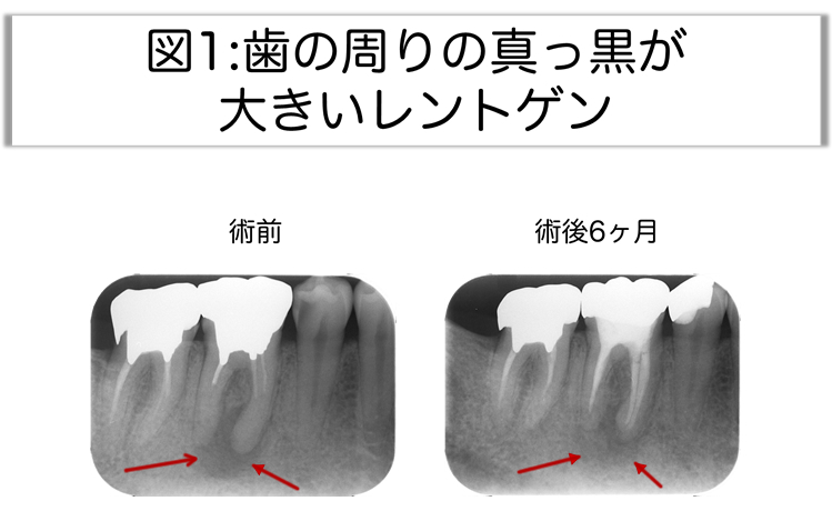 レントゲンで、歯の周りが真っ黒になっているのは、膿がたまっているから、と言われました。膿が大きいともう手遅れでしょうか？