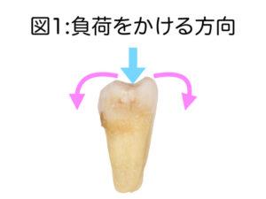根管治療後のかぶせ物について(パート1)～根管治療後の歯の補強について～