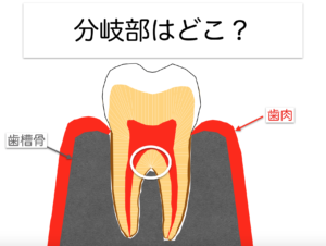 穴があいてる歯は治るか〜part4 分岐部穿孔症例〜