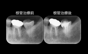 歯冠長延長術について〜矯正的挺出以外のフェルール獲得方法 その２〜