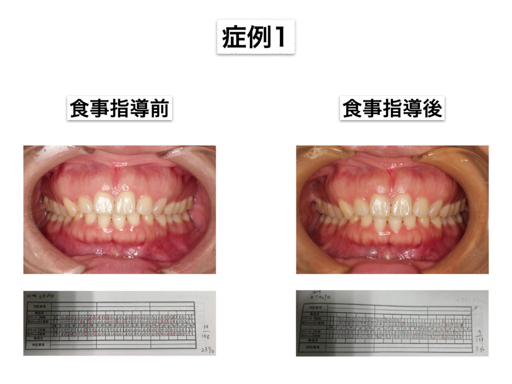歯周基本治療とTBIの結果について1