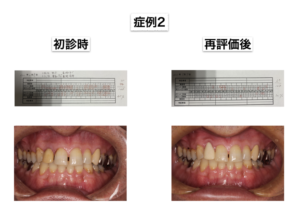 歯周基本治療とTBIの結果について2