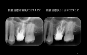 ももこ歯科での根管治療３〜サイナストラクトは治るのか２のつづき〜