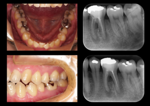 ももこ歯科での根管治療６〜サイナストラクトは治るのか 症例４歯内歯周病変編〜