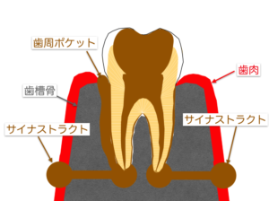 歯内歯周病変について