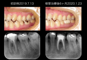 ももこ歯科での根管治療7〜サイナストラクトは治るのか 症例４歯内歯周病変編〜
