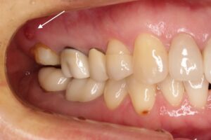 ももこ歯科での根管治療11〜サイナストラクトは治るのか症例５歯内歯周病変編〜