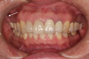 ももこ歯科での根管治療９〜サイナストラクトは治るのか症例５歯内歯周病変編〜